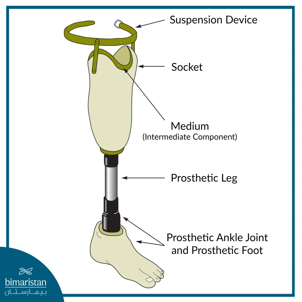 A Picture Illustrating The Components Of Prostheses Used When Fitting Prosthetic Limbs.