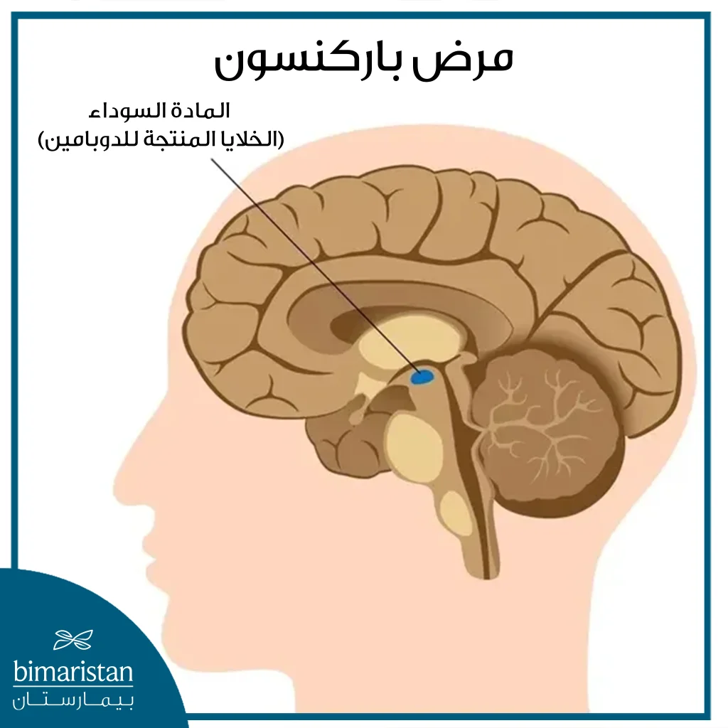 صورة تتحدث عن المادة السوداء التي تصاب في مرض باركنسون (الخلايا المفرزة لمادة الدوبامين)