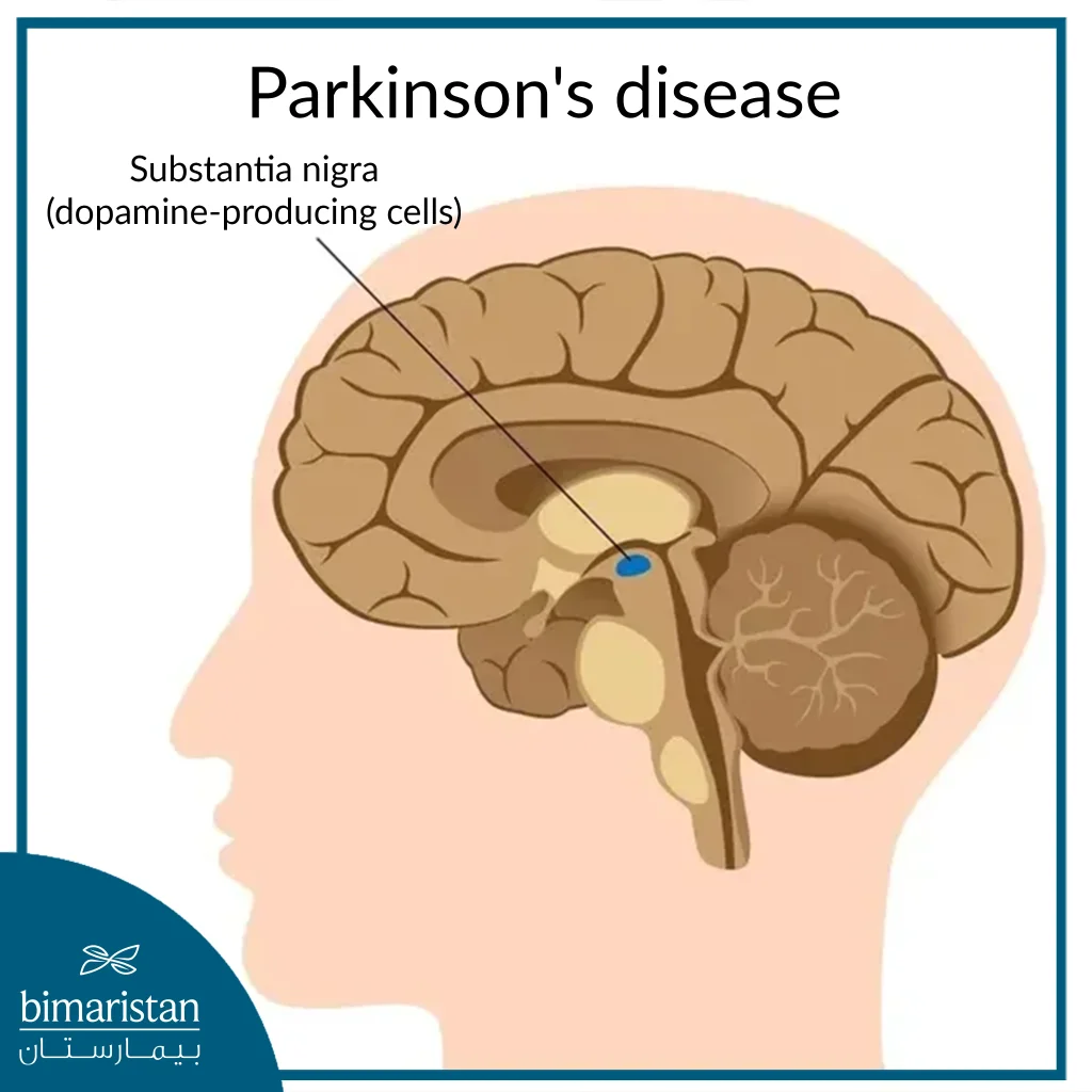 Image Of The Substantia Nigra Affected In Parkinson'S Disease (Dopamine-Secreting Cells) In Parkinson'S Disease