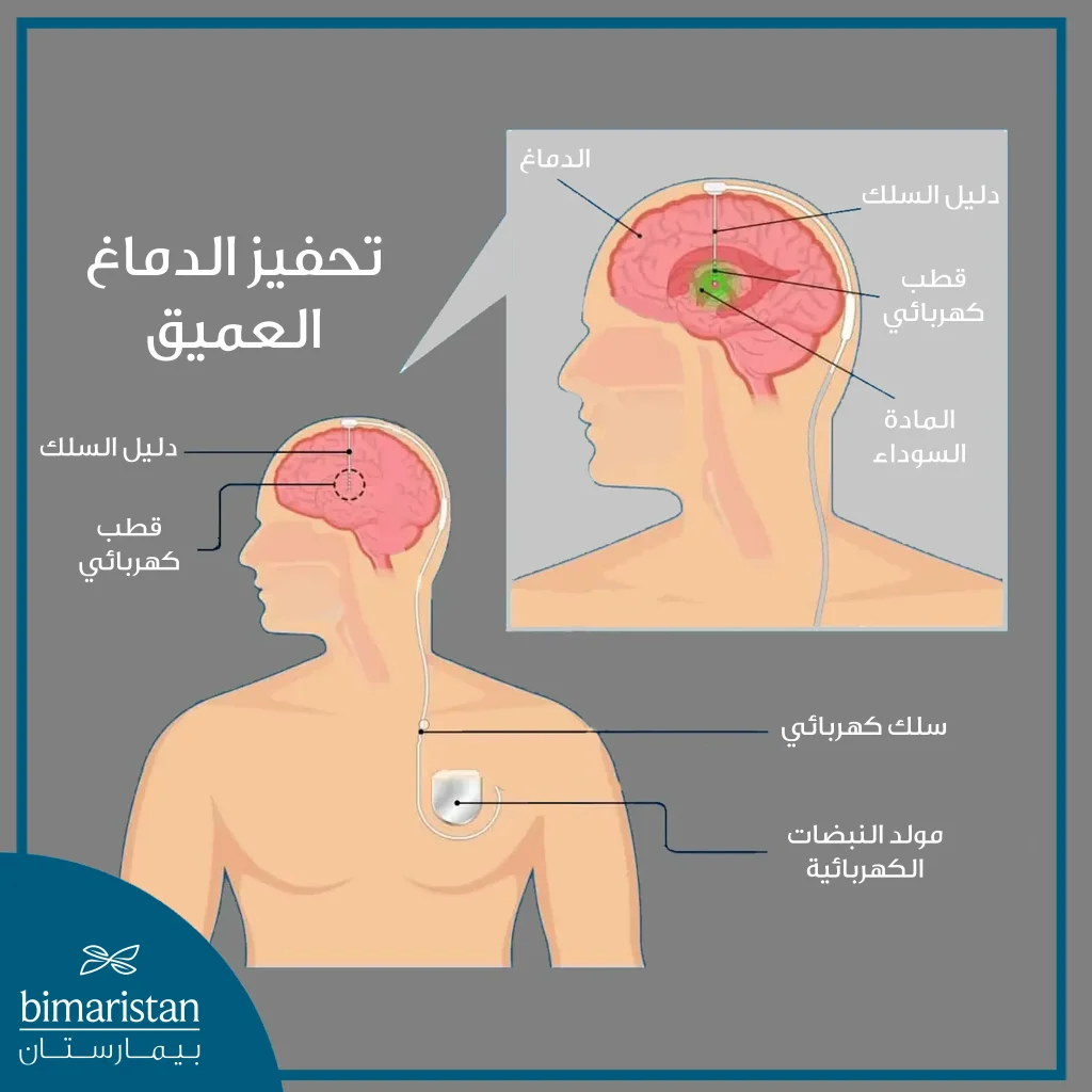 صورة تتحدث عن علاج مرض باركنسون عبر تحفيز الدماغ العميق