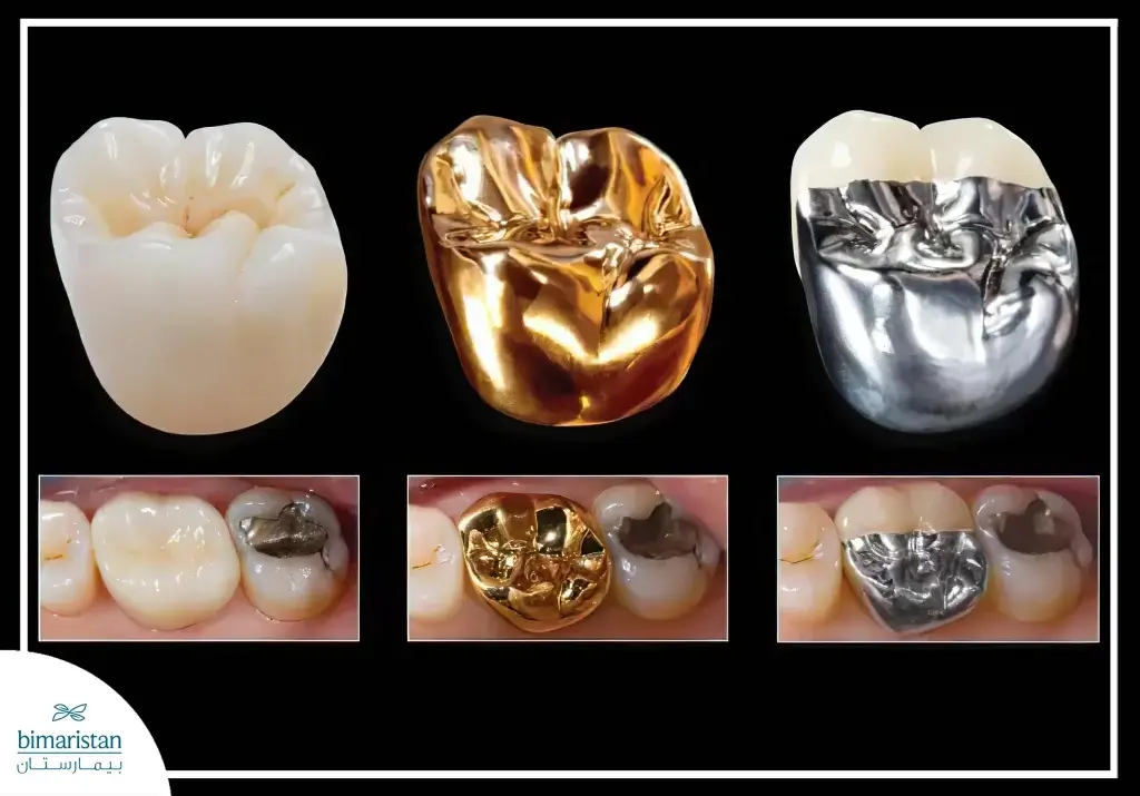 Crowns Are Made From A Variety Of Materials.