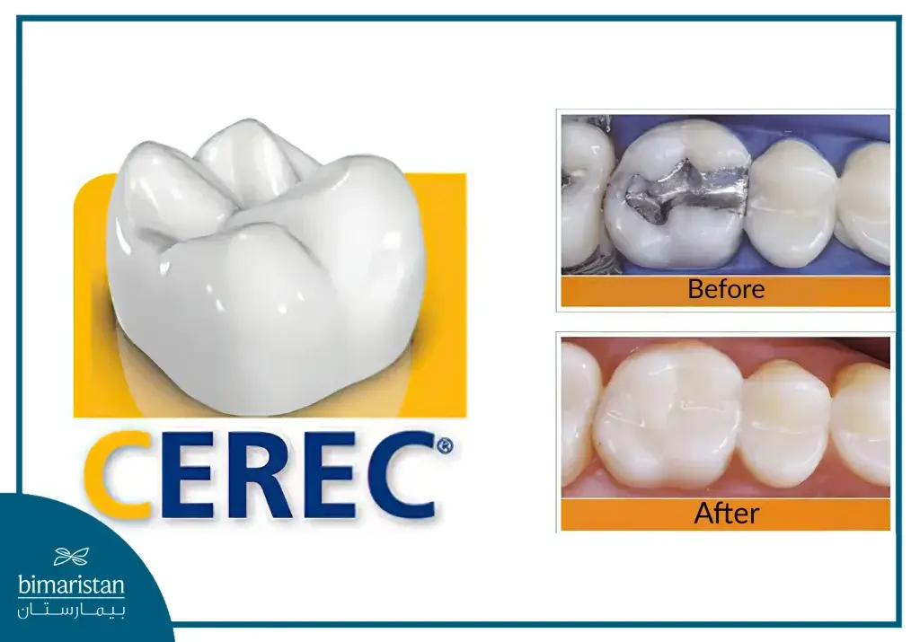 3D Dental Crowns In Turkey