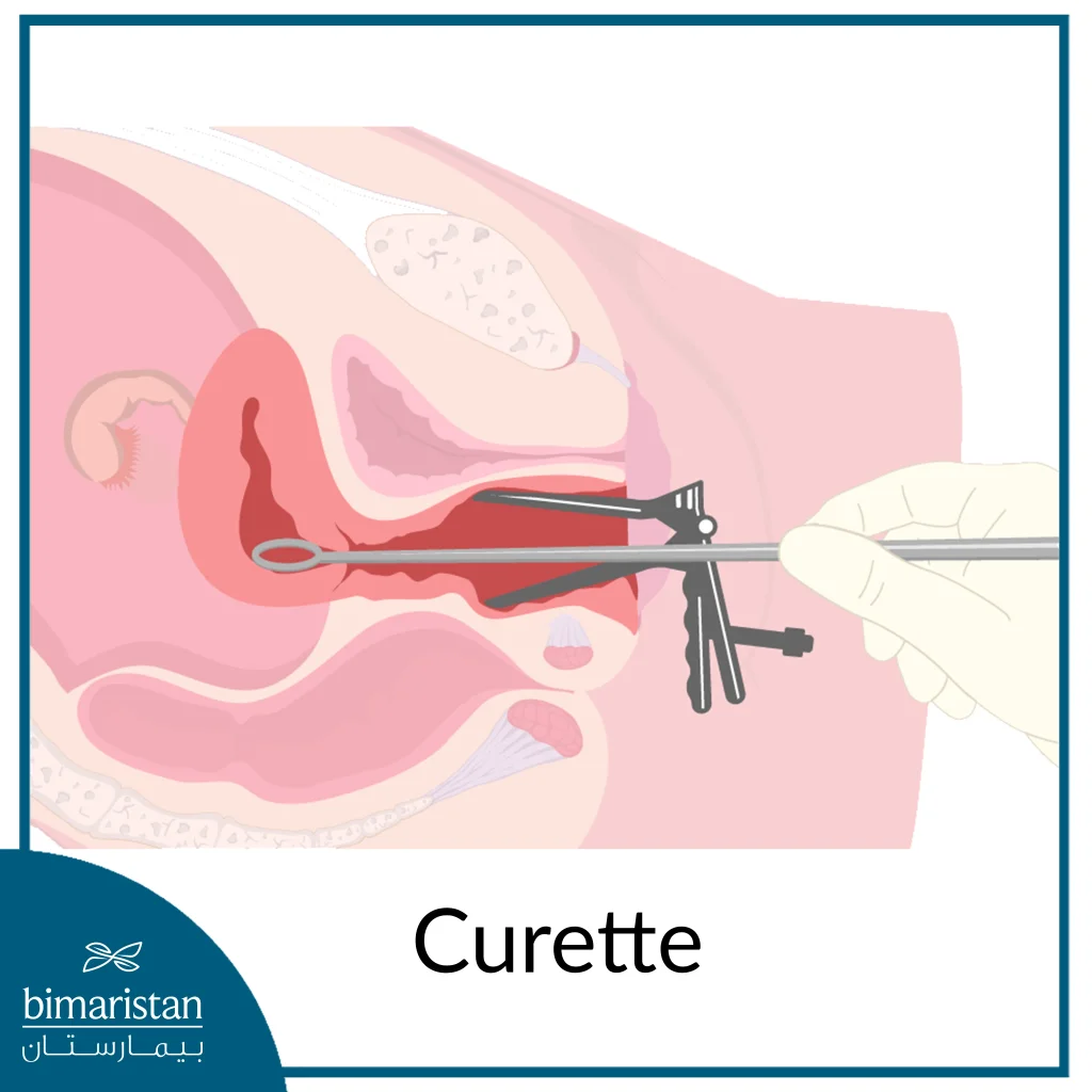 Dilation And Curettage Of The Uterus Is Done Using Two Instruments, The Dilator And The Curette