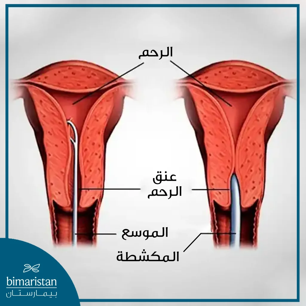 يتم توسيع عنق الرحم أولاً باستخدام الموسع ثم كشط باطن الرحم باستخدام المكشطة