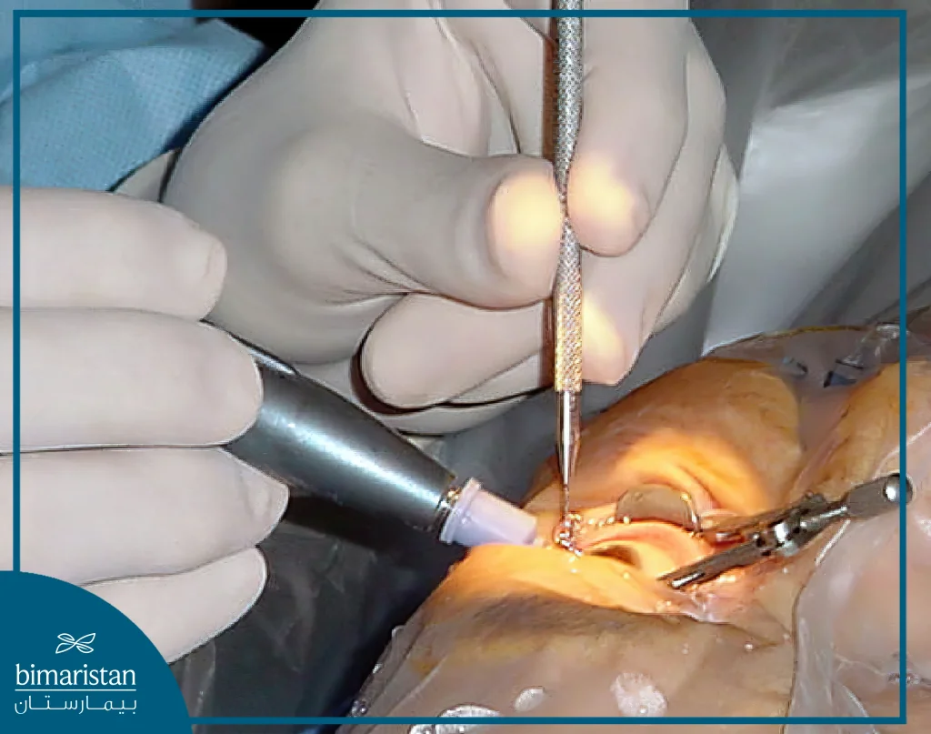 Lens Replacement Surgery In Turkey - Cataract Surgery