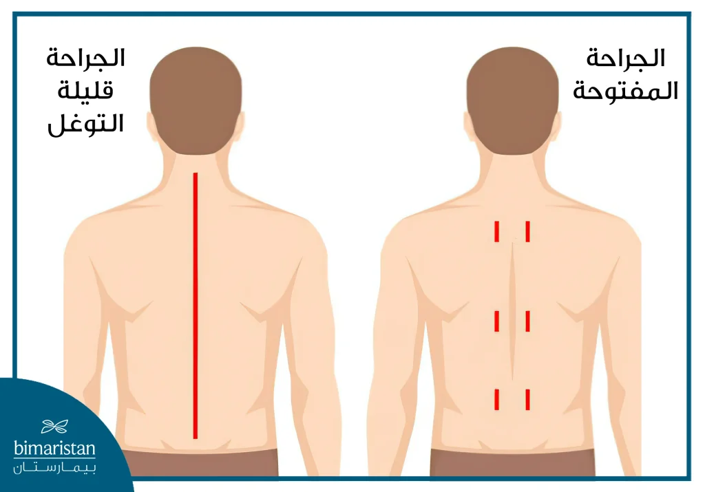 مقارنة بين الشقوق الجراحية المحدثة بالجراحة التقليدية والجراحة طفيفة التوغل
