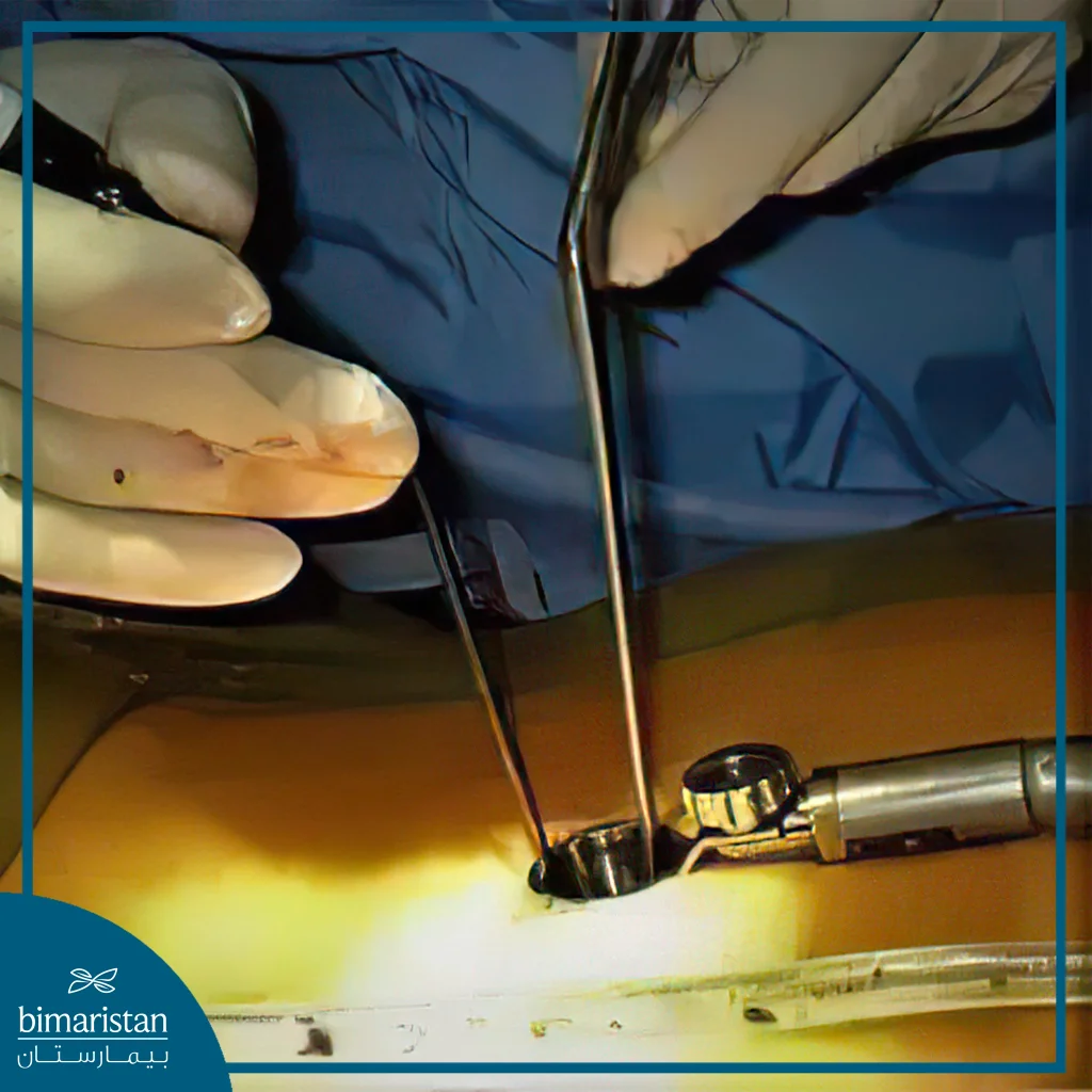 Minimally Invasive Spine Surgery



