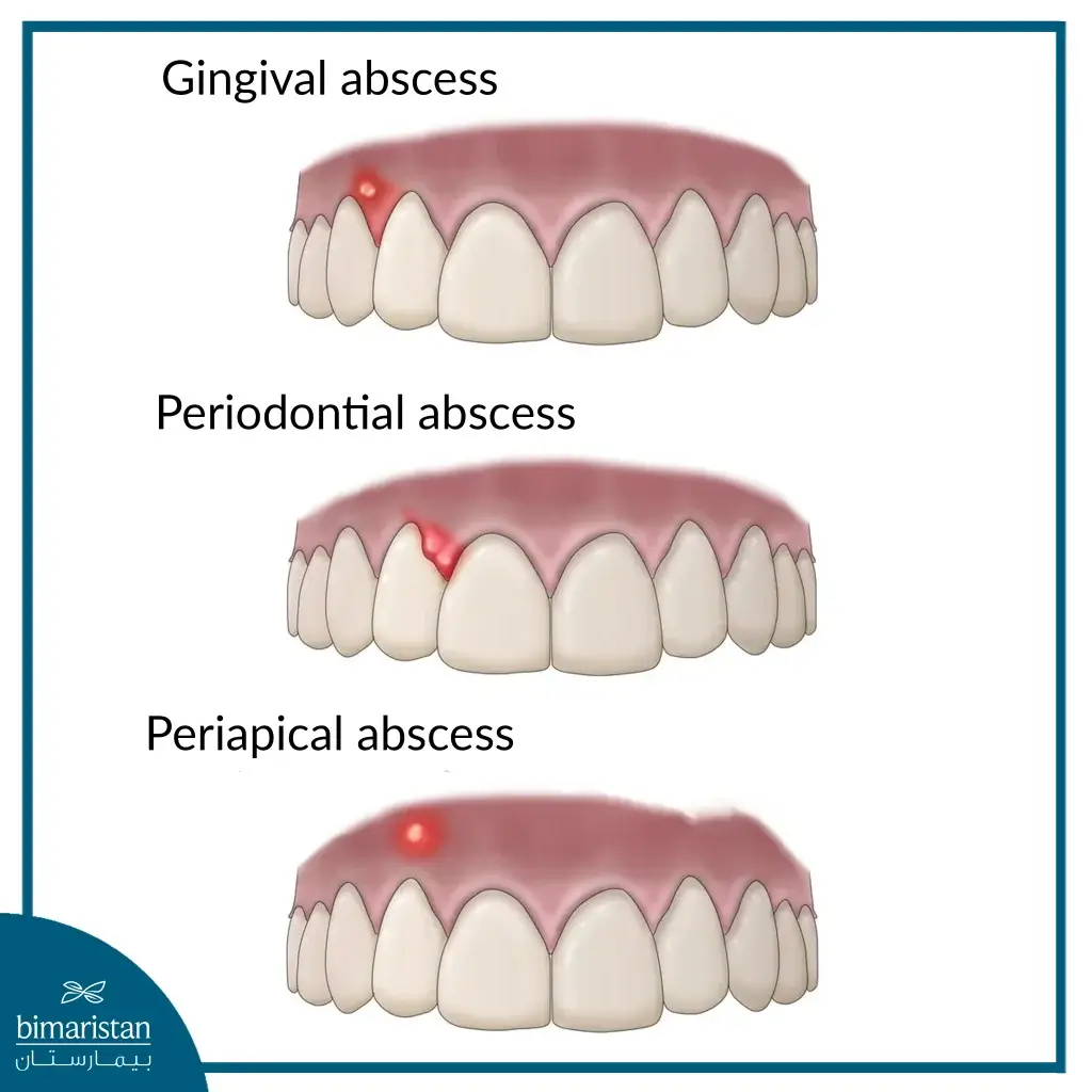 Types Of Abscesses That May Appear In The Mouth