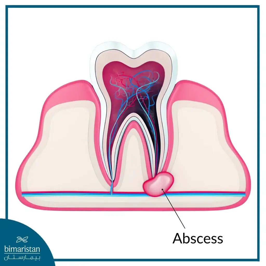 Dental Abscess