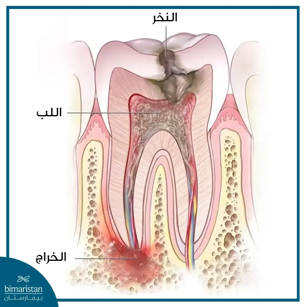 عدم علاج النخر قد يؤدي لظهور خراج الأسنان