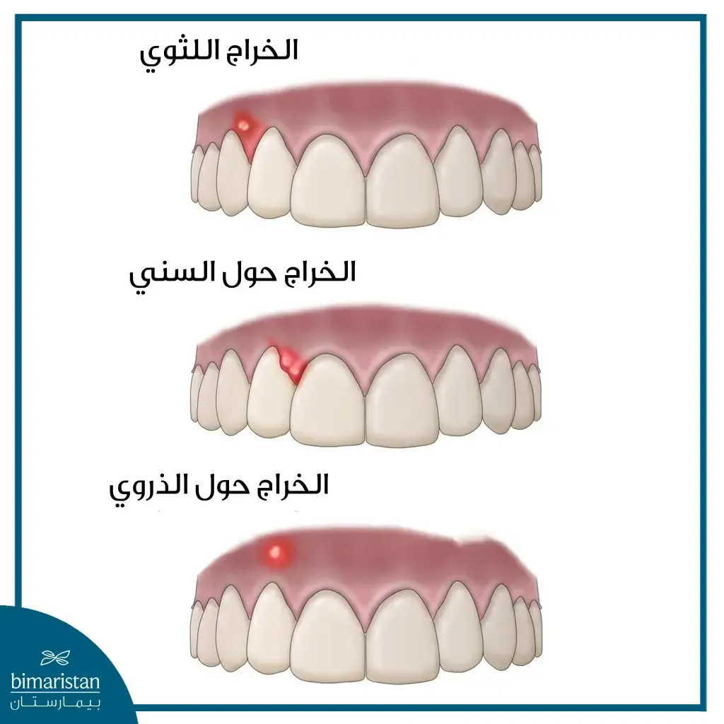 أنواع الخراجات التي قد تظهر في الفم