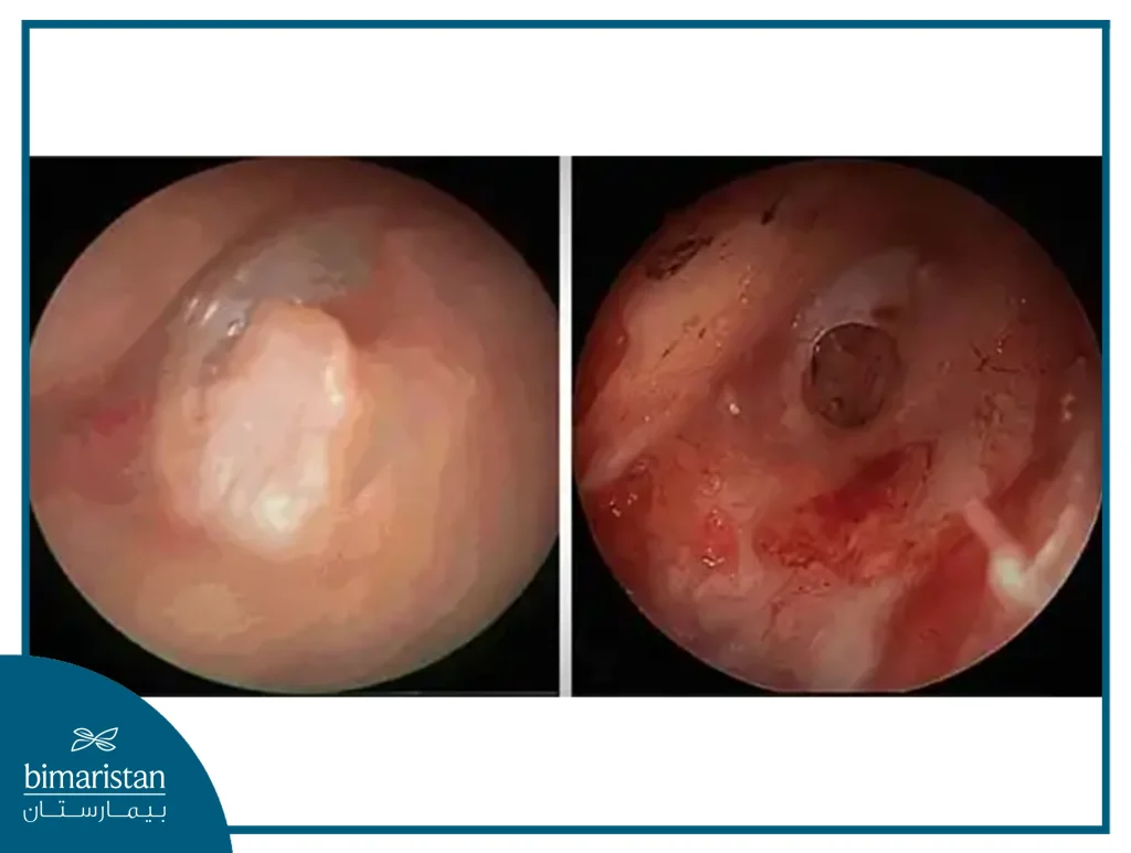 Picture Of The Tympanoplasty Operation And The Shape Of The Eardrum Before And After The Operation