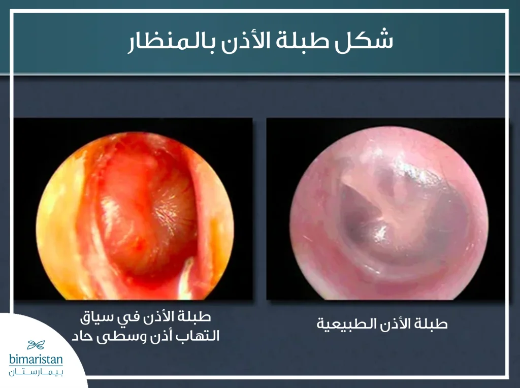 صور مأخوذة بالمنظار توضح الفرق بين طبلة الأذن الطبيعية والطبلة في سياق التهاب الأذن الوسطى