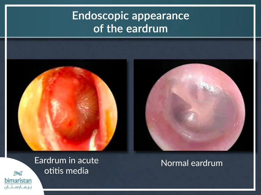 Endoscopic Images Showing The Difference Between A Normal Eardrum And A Tympanic Membrane In The Context Of Acute Otitis Media