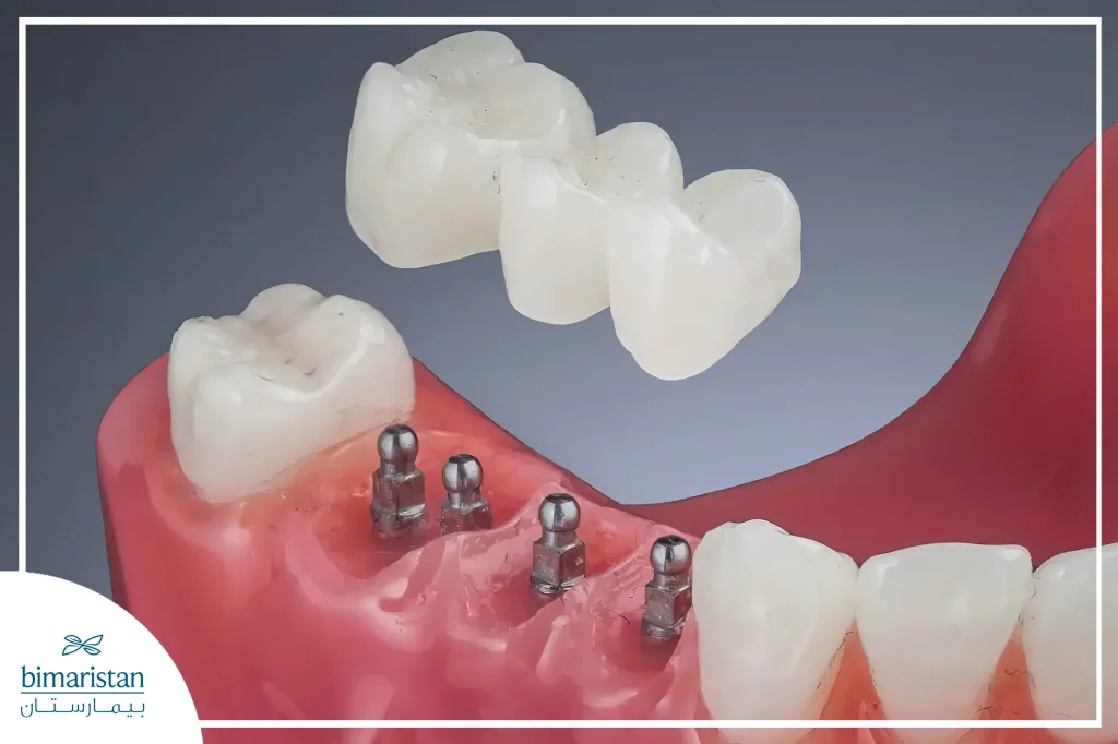 Mini Dental Implants (Same-Day Implants)