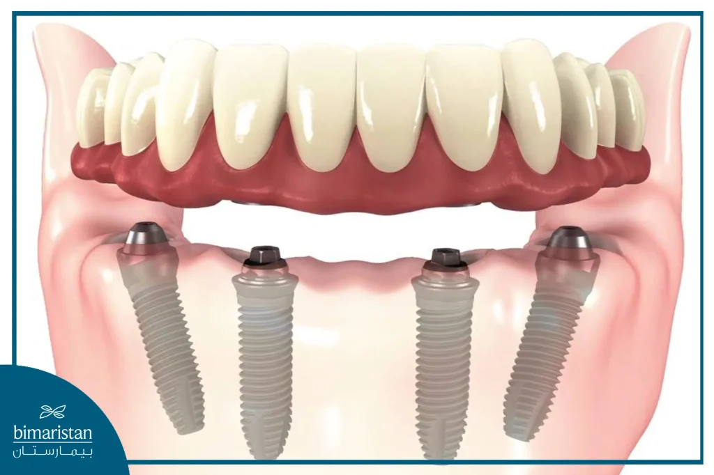 All On Four Dental Implants