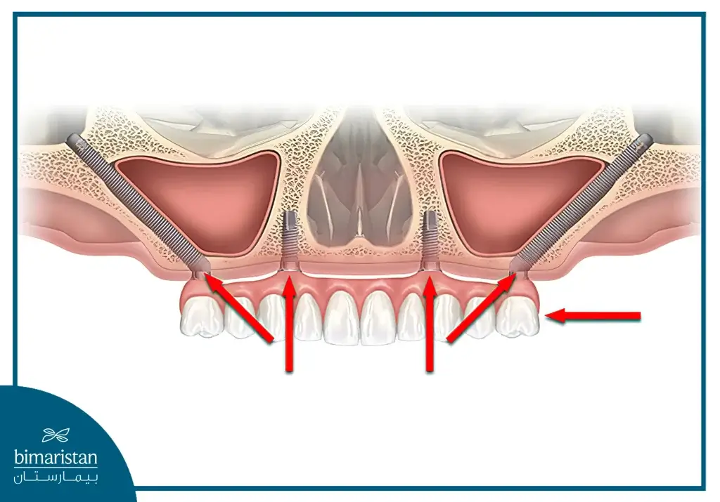 All-On-4 Dental Implants At Suitable Angles