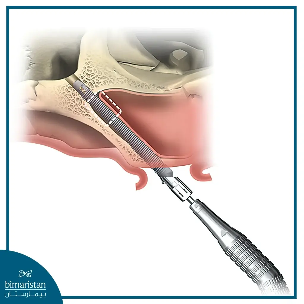 Dental Implant Screw Placement Between Maxillary Sinuses