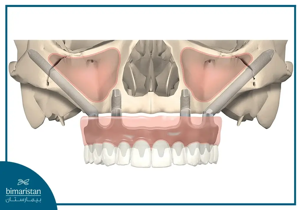 All-On-Four Dental Implants With Maxillary Sinus Avoidance