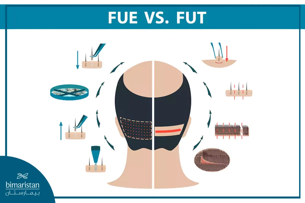 صورة توضح الفرق بين زراعة الشعر بالاقتطاف Fue وزراعة الشعر بزراعة حدة البصيلات Fut