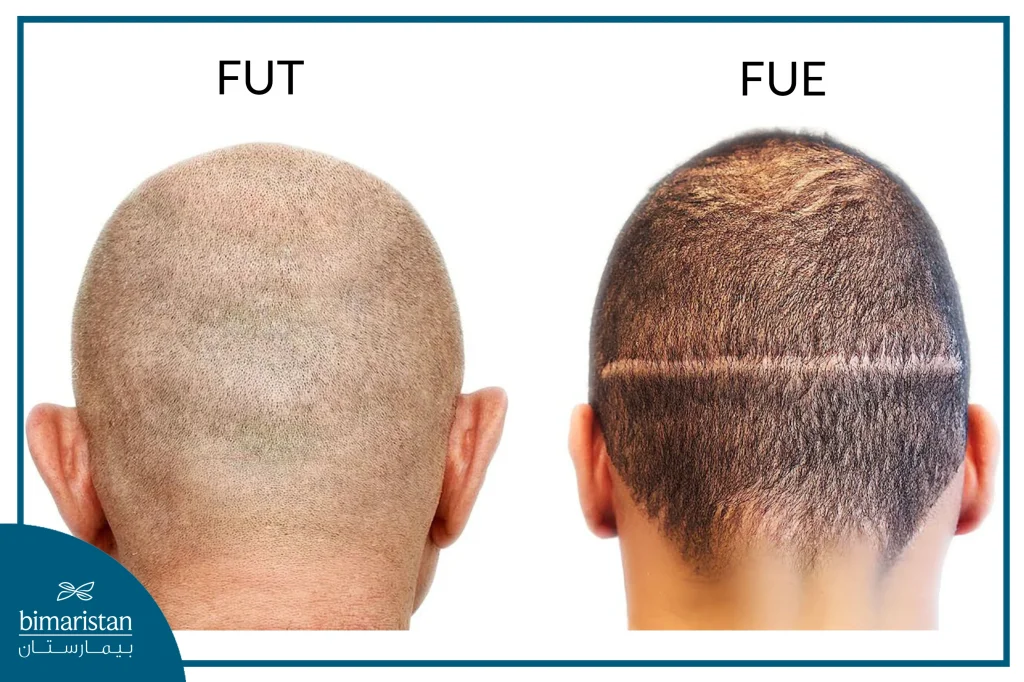 A Picture Of The Heads Of Two People Who Underwent Two Different Hair Transplant ,Fut And Fue