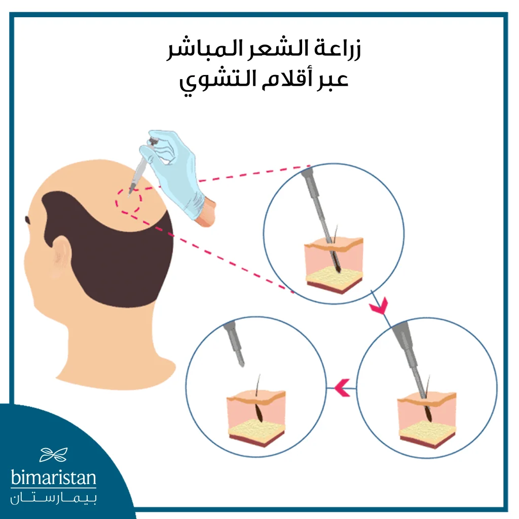 صورة توضح تقنية زراعة الشعر المباشر عبر أقلام التشوي Dhi Choi