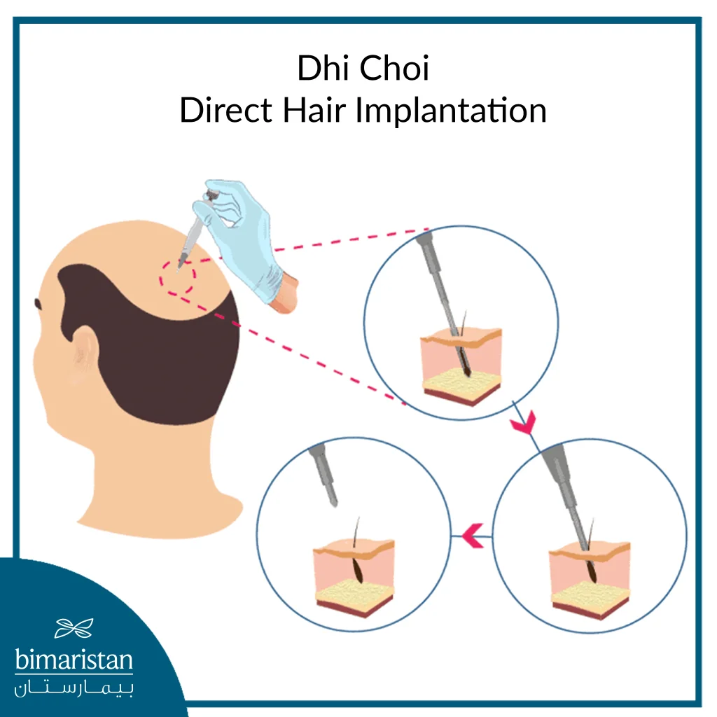 Image Showing The Direct Hair Transplantation Technique Using Dhi Choi