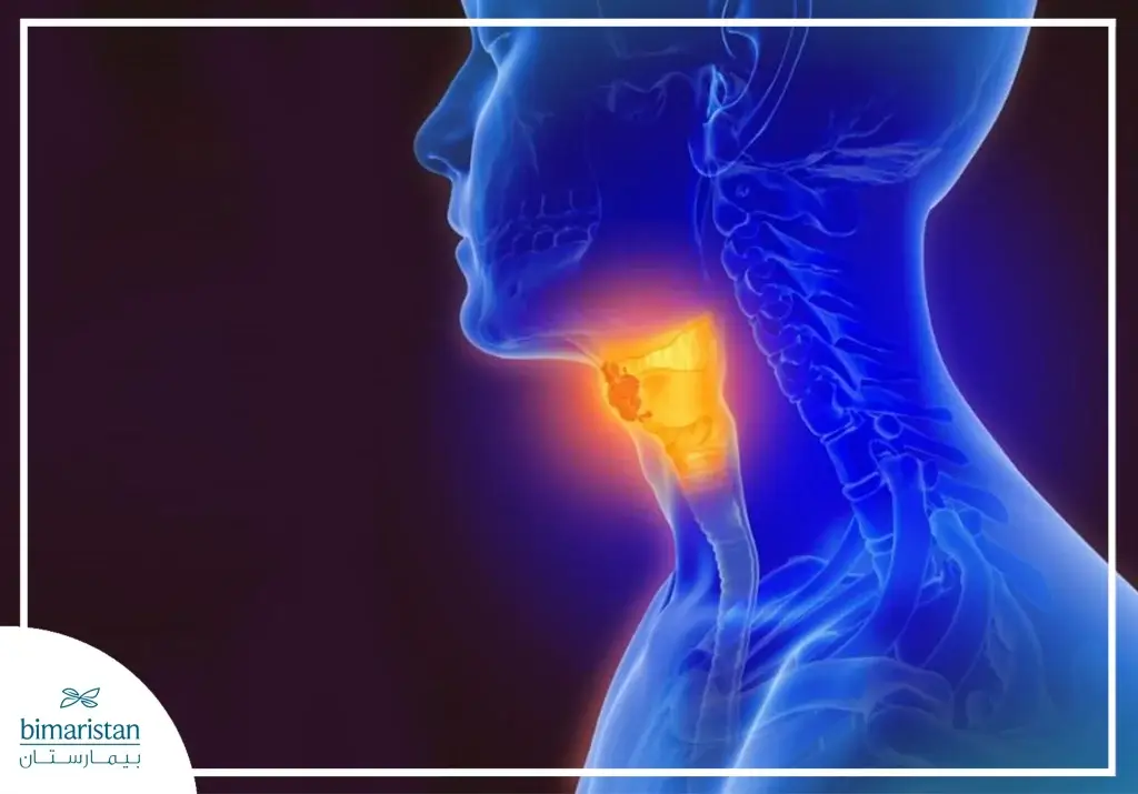 Laryngeal Cancer