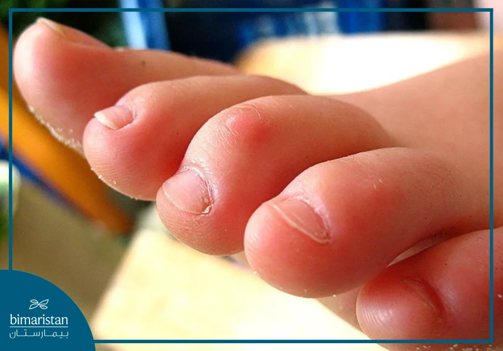 Hammertoes In Children