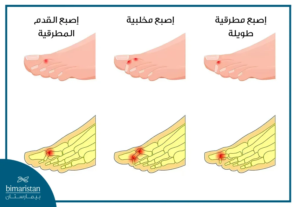 أنواع-أصابع-القدم-المطرقية