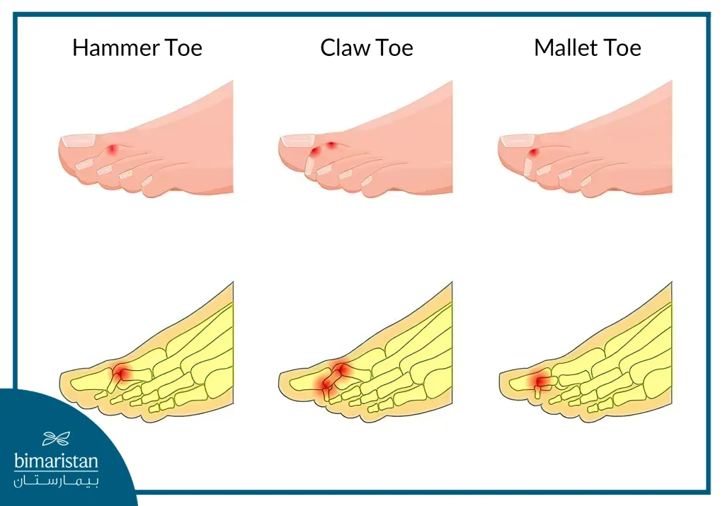 Types Of Hammertoes