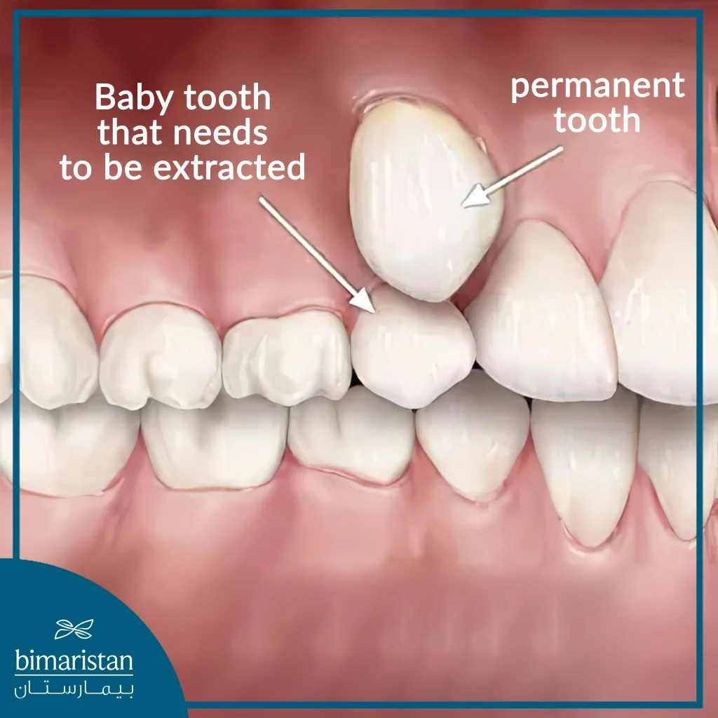 A Temporary Tooth That Must Be Removed To Make Room For A Permanent Tooth To Emerge.