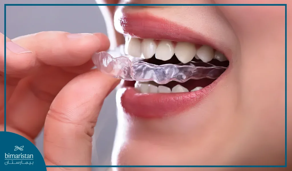 Crowded Teeth Treatment With Clear Aligners In Istanbul