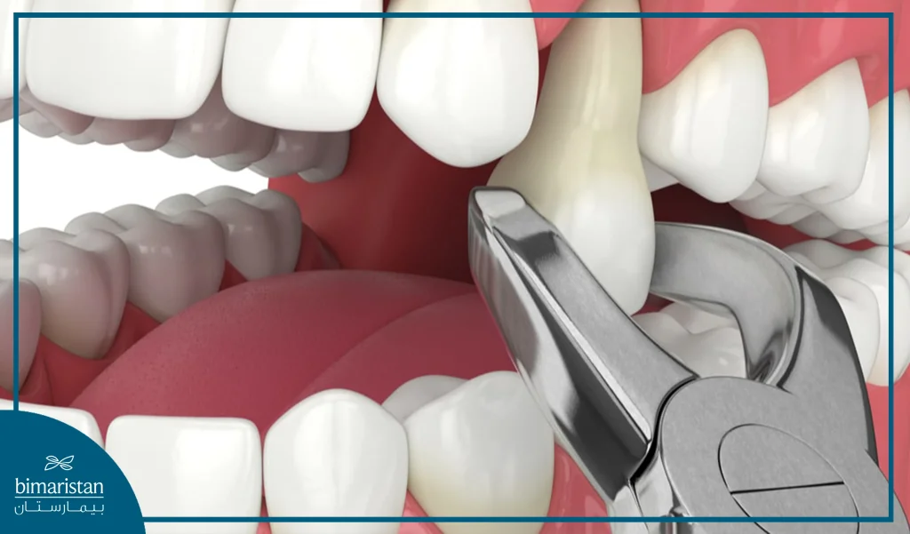 You May Have To Extract Some Teeth During Treatment Of Crowded Teeth.