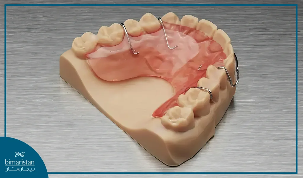 Post-Orthodontic Retainers For Treating Crowded Teeth