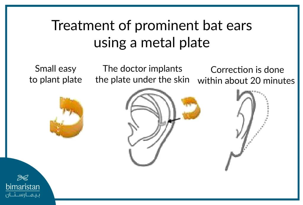 A Picture Showing The Treatment Of Bat Ear Using A Metal Plate, The Shape Of The Plate And How It Is Placed On The Ear