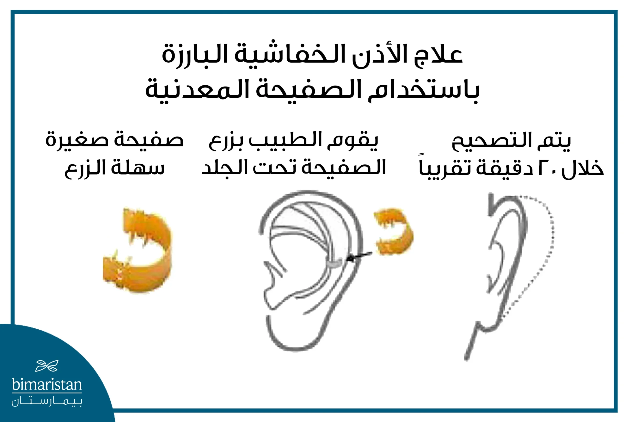 صورة تبين علاج الاذن الخفاشية باستخدام الصفيحة المعدنية وشكل الصفيحة وكيف توضع على الأذن