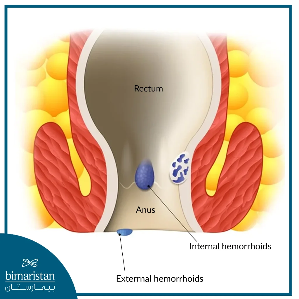 Internal Hemorrhoids Develop In The Rectum Or Anal Canal While External Hemorrhoids Can Be Seen Around The Anus.