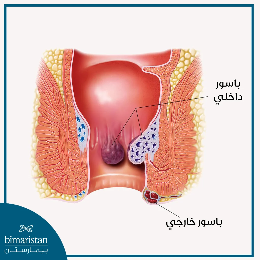 تتشكل البواسير الخارجية بالقرب من الشرج بينما تتشكل البواسير الداخلية بداخل المستقيم حتى الحافة الشرجية