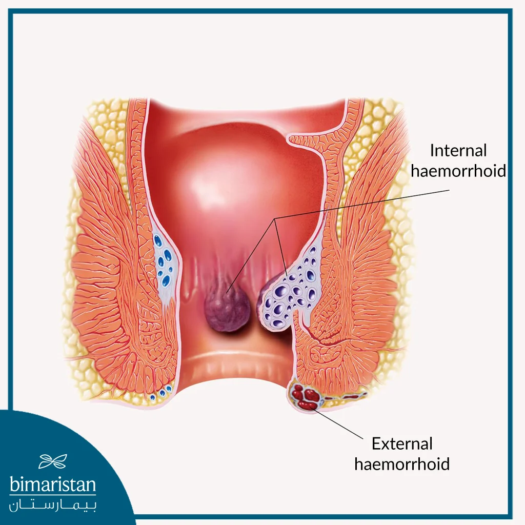 External Hemorrhoids Form Near The Anus While Internal Hemorrhoids Form Inside The Rectum Up To The Anal Edge