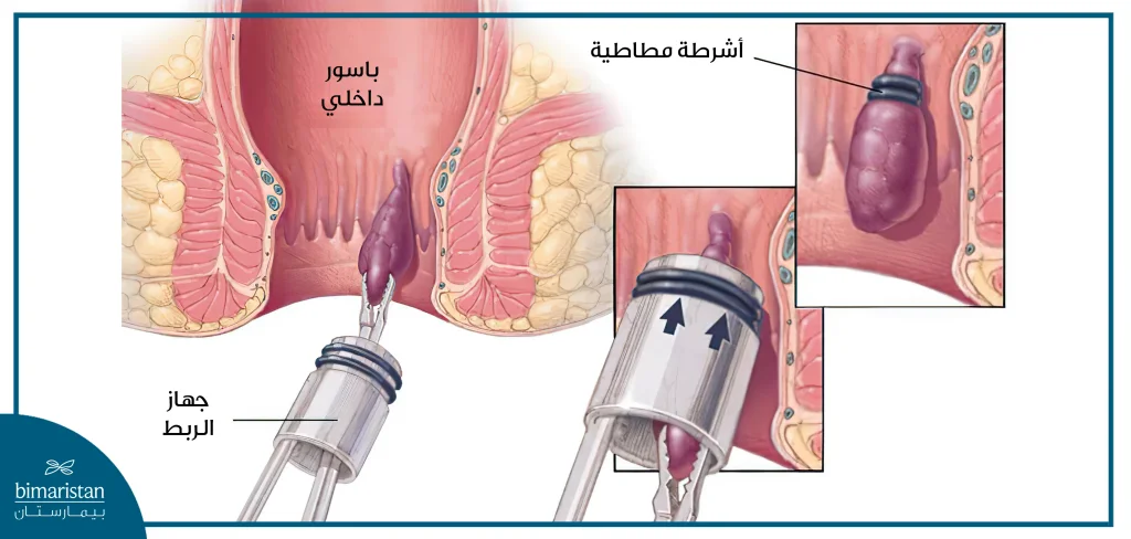 يقوم جهاز الربط بربط قاعدة الباسور الداخلي بالشريط المطاطي لقطع التروية الدموية عنه