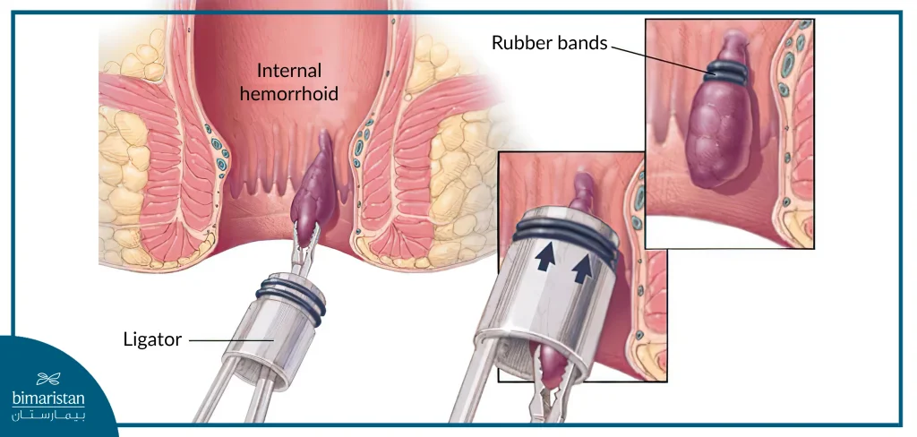 Image Showing Hemorrhoids Treatment With Rubber Band Ligation