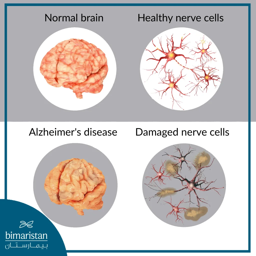 Stem Cell Therapy For Alzheimer'S Aims To Regenerate Damaged Nerve Cells In The Brain Of An Alzheimer'S Patient, As Shown In This Image