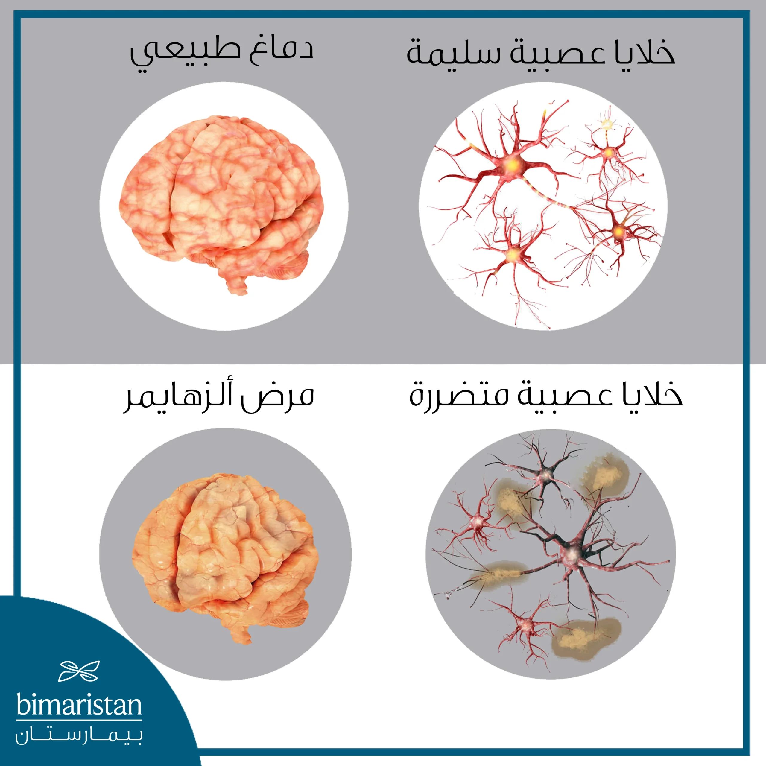 يهدف علاج الزهايمر بالخلايا الجذعية لتجديد الخلايا العصبية المتضررة في دماغ مريض الزهايمر كما توضح هذه الصورة