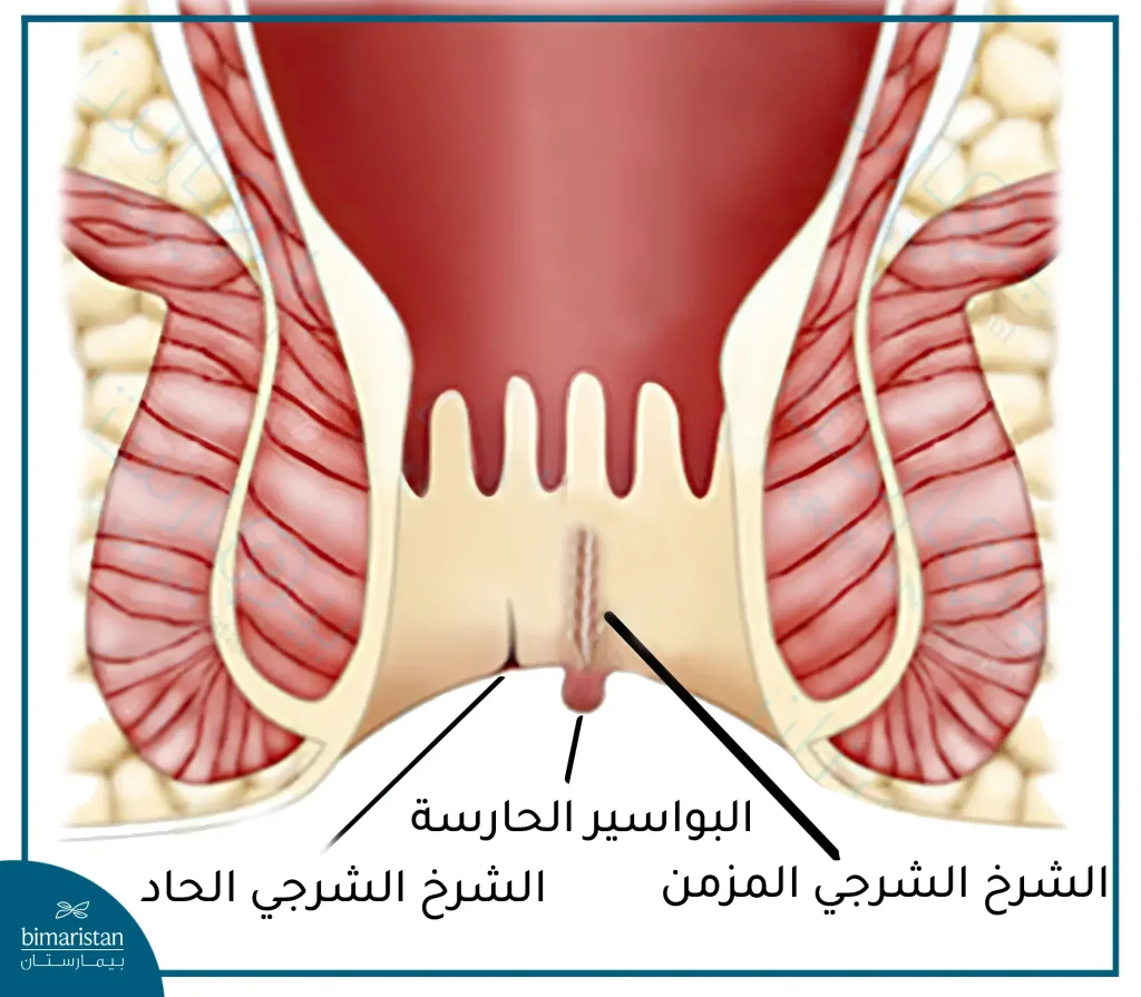 يتميز الشرخ الشرجي المزمن بتشكل علامات الإزمان كظهور النسيج الندبي كما قد يترافق مع البواسير الحارسة