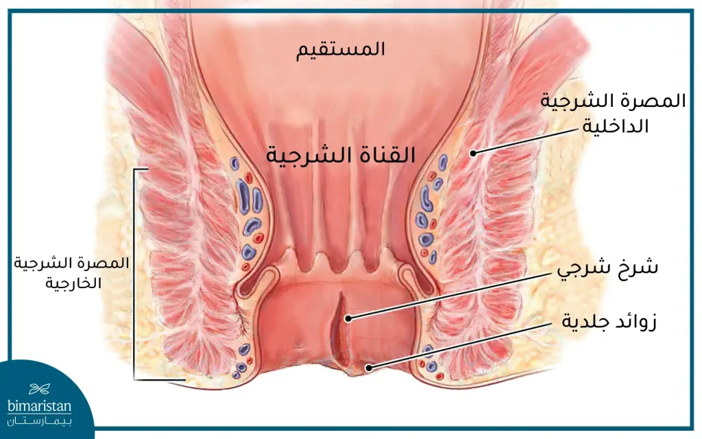 شرخ شرجي في القناة الشرجية مع زوائد جلدية عند فتحة الشرج