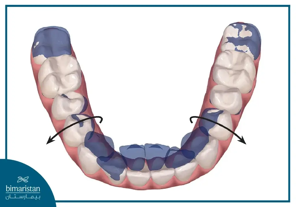 Bite Lift Device For Deep Bite Treatment In Istanbul