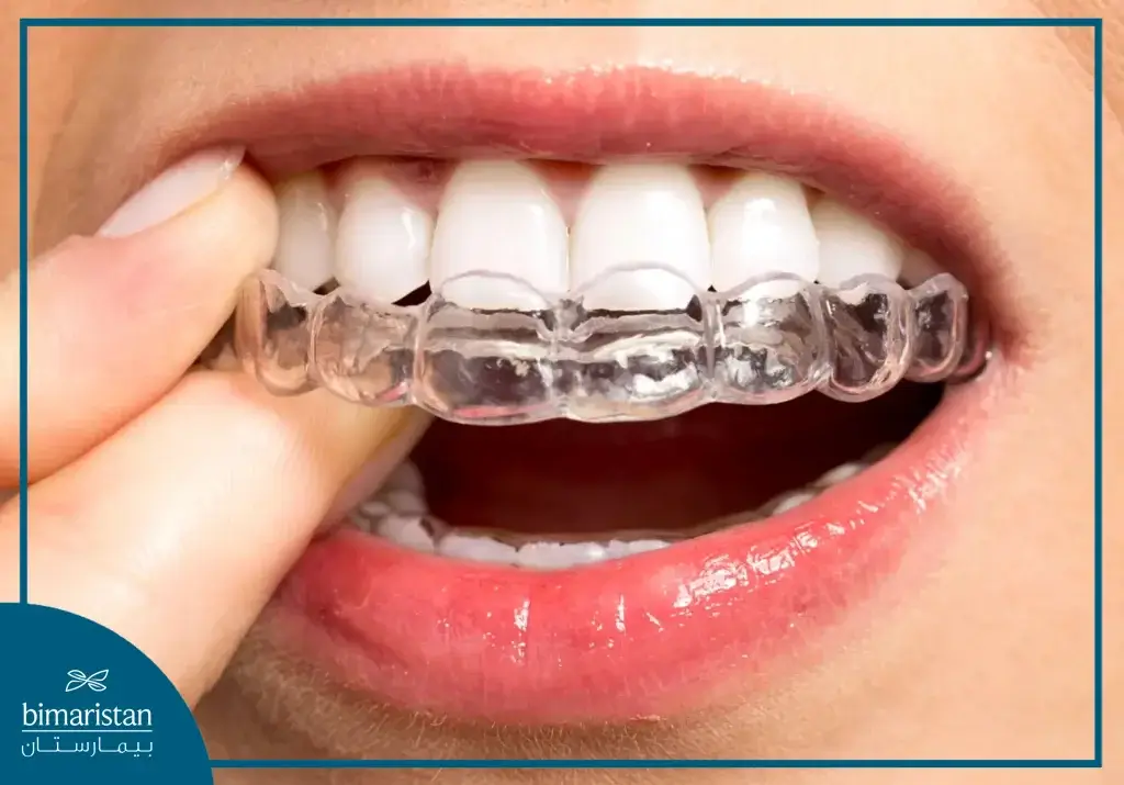 Clear Aligners