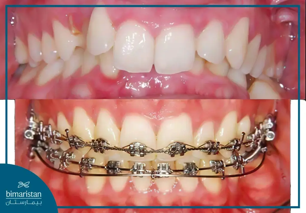 Orthodontic Braces