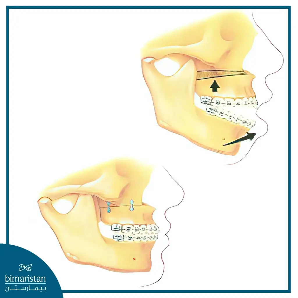 Open Bite Treatment With Orthognathic Surgery In Turkey